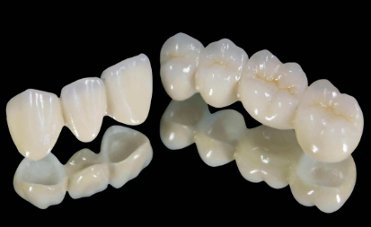 全瓷牙為什么比烤瓷牙貴